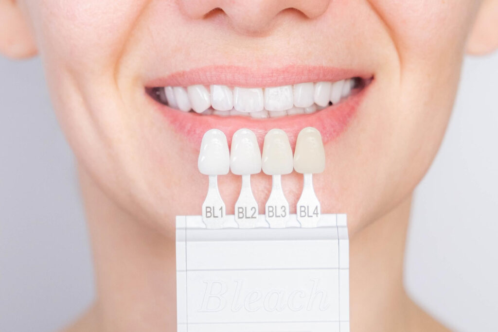 Perfect white veneers smile with shade guide bleach color tooth dental whitening bleaching quality control and color check at artificial dentition female veneer and zircon  smile dental care and stomatology